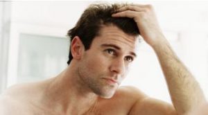 alopecia masculina